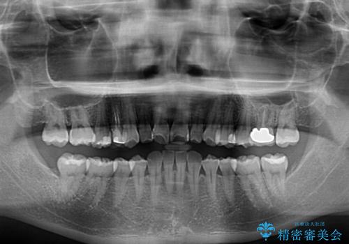 先天欠損のある歯列　インビザライン矯正の治療前