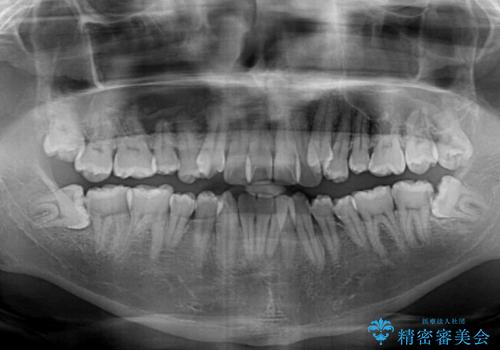 八重歯とクロスバイト 目立たないワイヤー装置で矯正治療の治療前