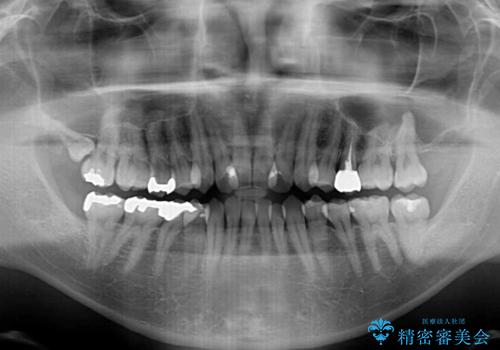 前歯のクロスバイト　目立たないワイヤー装置で矯正治療の治療前