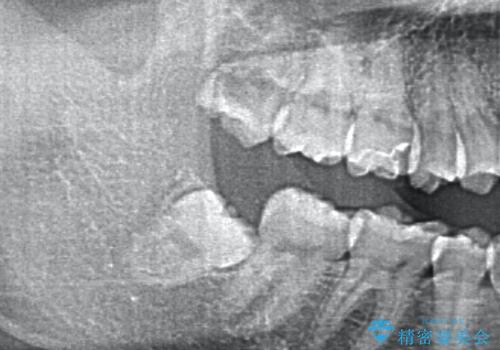 リラックス麻酔 (静脈内鎮静下)での親知らず抜歯の症例 治療前
