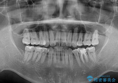 後戻りでデコボコの前歯 インビザライン矯正治療の治療前