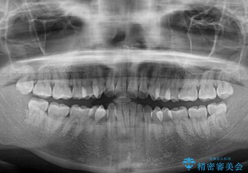 抜歯矯正で唇を閉じやすく 目立たないワイヤー装置の治療前