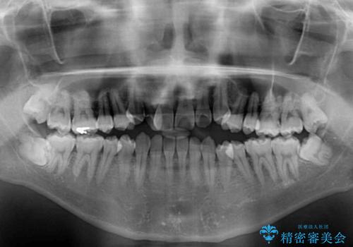 左右の八重歯が気になる　ワイヤー装置での咬み合わせ改善の治療前