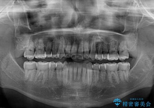 八重歯とクロスバイト 目立たないワイヤー装置で矯正治療の治療後