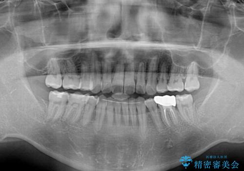 後戻りでデコボコの前歯 インビザライン矯正治療の治療後