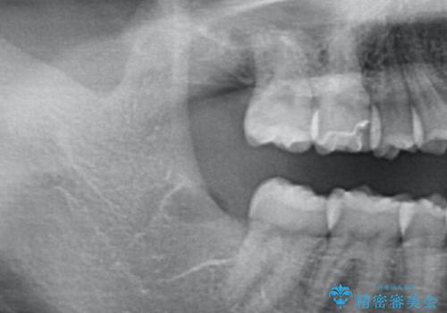 リラックス麻酔 (静脈内鎮静下)での親知らず抜歯の症例 治療後