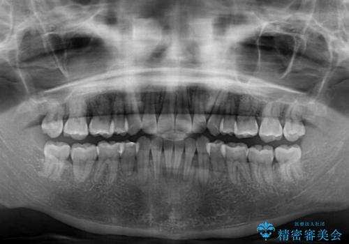 抜歯矯正で唇を閉じやすく 目立たないワイヤー装置の治療後