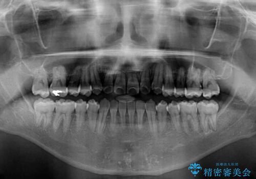 左右の八重歯が気になる ワイヤー装置での咬み合わせ改善の治療後