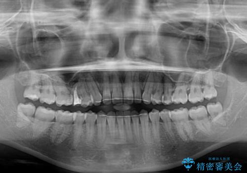隙間だらけの歯列 インビザラインで改善の治療後