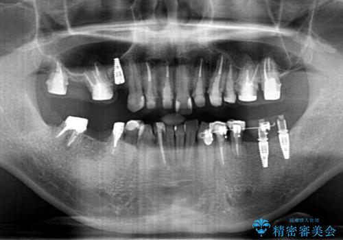 全ての歯を治療したいの治療中