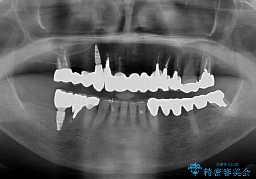 前歯をきれいにしたい　インプラントや部分矯正を用いた総合歯科治療の治療後