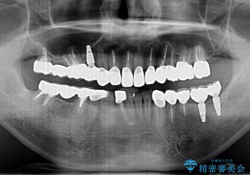 全ての歯を治療したいの治療後