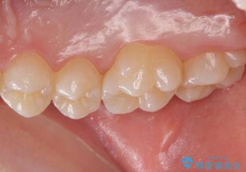 歯と歯の間の虫歯　セラミックインレーでの治療の治療前