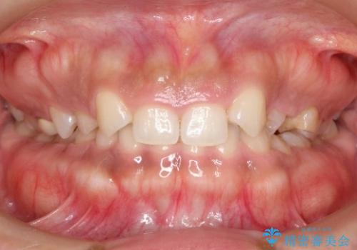 【総合歯科治療】インプラント+インビザラインの症例 治療前