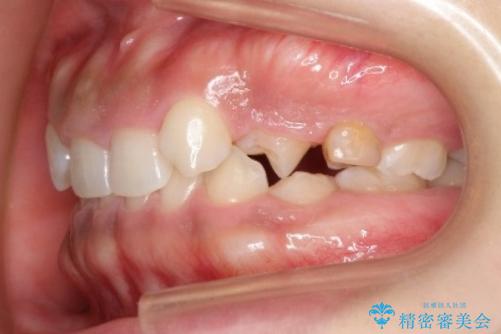 【総合歯科治療】インプラント+インビザラインの治療前