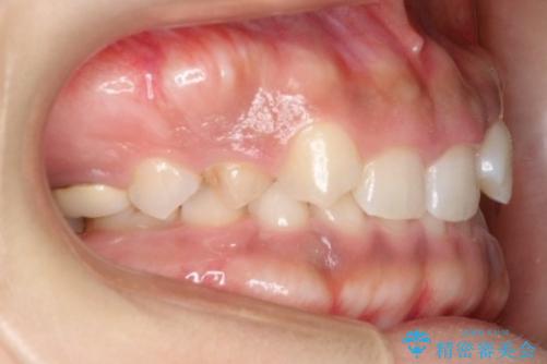 【総合歯科治療】インプラント+インビザラインの治療前