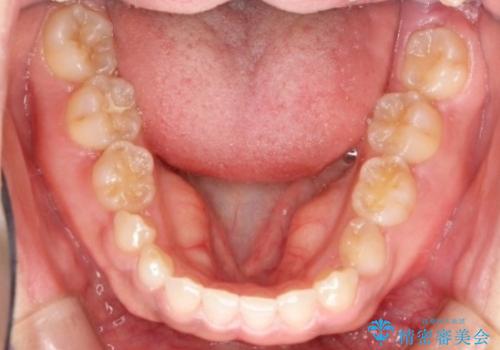 【総合歯科治療】インプラント+インビザラインの治療前