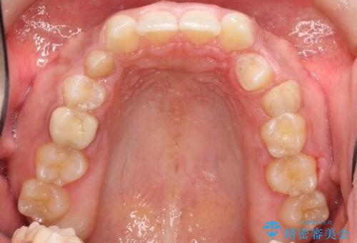 【総合歯科治療】インプラント+インビザラインの治療前