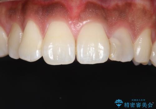 【オールセラミッククラン】歯の色が気になるの治療前