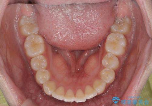 矯正治療を途中でやめてしまった、途中からの治療希望の治療後