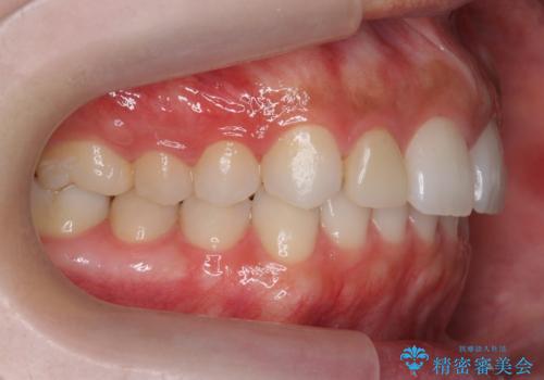 前歯が出っ歯ですきっ歯 抜かずに前歯を見た目良くの治療後