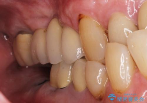 【インプラント】 他院で入れた被せ物が取れたの治療前