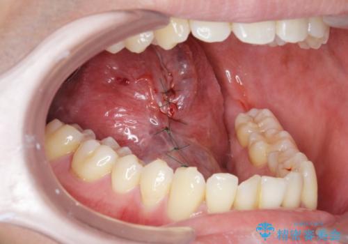 滑舌の改善をしたいの治療中