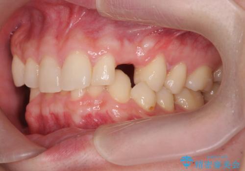 前歯に目立たないノンクラスプデンチャーを作りたいの症例 治療前
