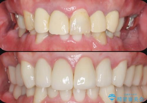 全ての歯を治療したい