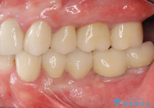 全ての歯を治療したいの治療後