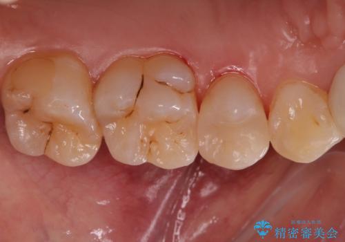 銀の詰め物を白くしたい セラミックインレーでの治療の治療後