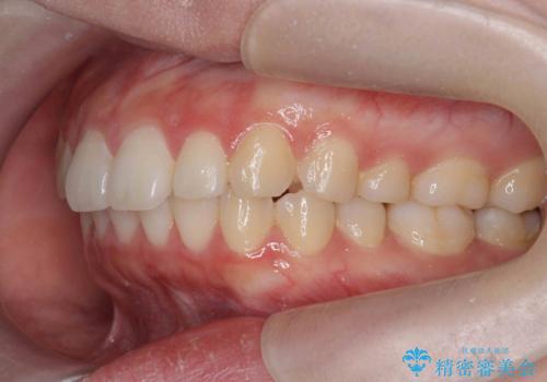 矯正治療を途中でやめてしまった、途中からの治療希望の治療後