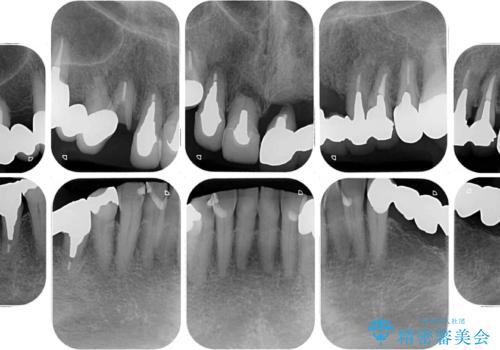 前歯をきれいにしたい インプラントや部分矯正を用いた総合歯科治療の治療前