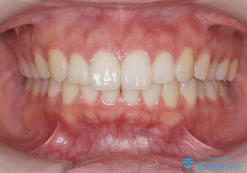 矯正治療を途中でやめてしまった、途中からの治療希望の症例 治療後