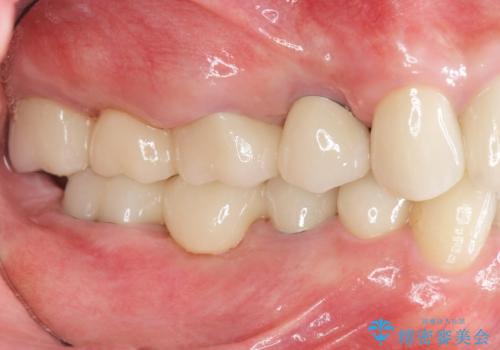 全ての歯を治療したいの治療後