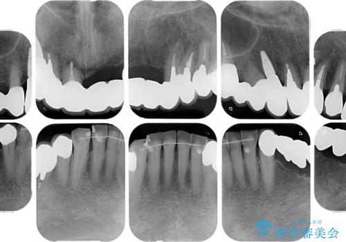 前歯をきれいにしたい　インプラントや部分矯正を用いた総合歯科治療の治療後