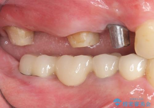 全ての歯を治療したいの治療中