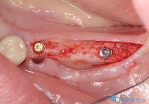 臼歯部の欠損 インプラント補綴の治療中
