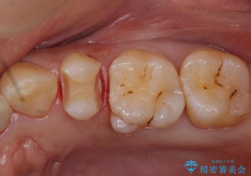 銀の詰め物を白くしたい セラミックインレーでの治療の治療中