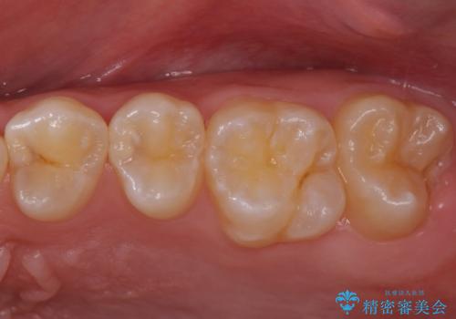 歯と歯の間の虫歯　セラミックインレーでの治療の治療前