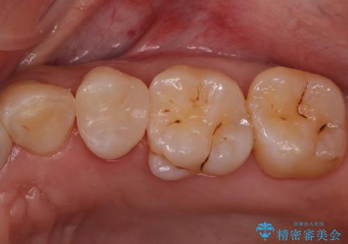 銀の詰め物を白くしたい セラミックインレーでの治療の治療後