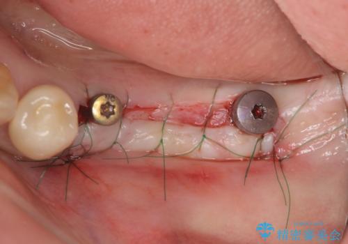 臼歯部の欠損 インプラント補綴の治療中