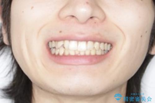 インビザライン:前歯のがたつきと噛み合わせの治療の治療前（顔貌）