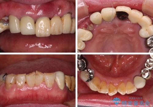 前歯をきれいにしたい インプラントや部分矯正を用いた総合歯科治療の治療前