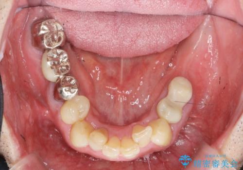 全ての歯を治療したいの治療前