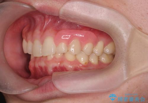 前歯に目立たないノンクラスプデンチャーを作りたいの症例 治療後