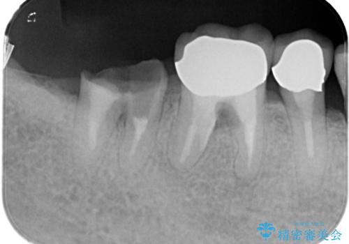 【インプラント】 他院で入れた被せ物が取れたの治療前