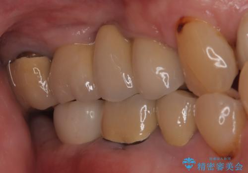 【インプラント】 他院で入れた被せ物が取れたの治療後