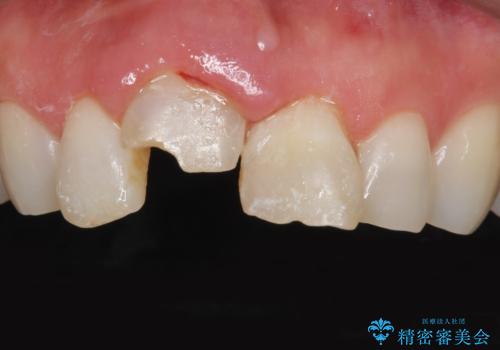 転んで前歯を折った　歯を抜かない治療の症例 治療前