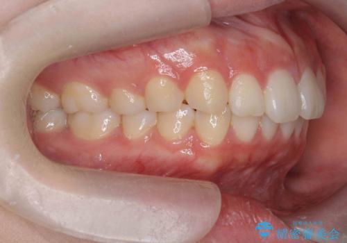 矯正治療を途中でやめてしまった、途中からの治療希望の治療後